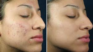 Chemical Peel for Acne (After 2 sessions)