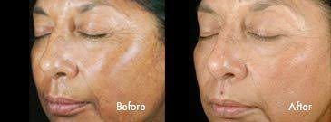 Chemical Peel for Pigmentation (After 4 sessions)